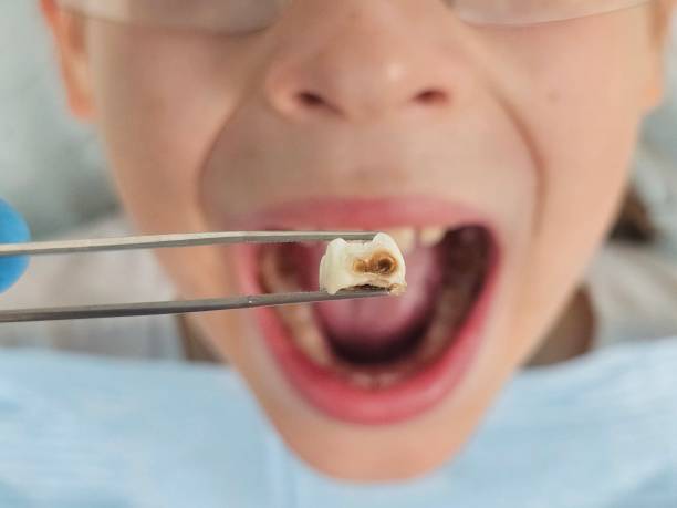 Best Emergency Tooth Extraction in Harkers Island, NC